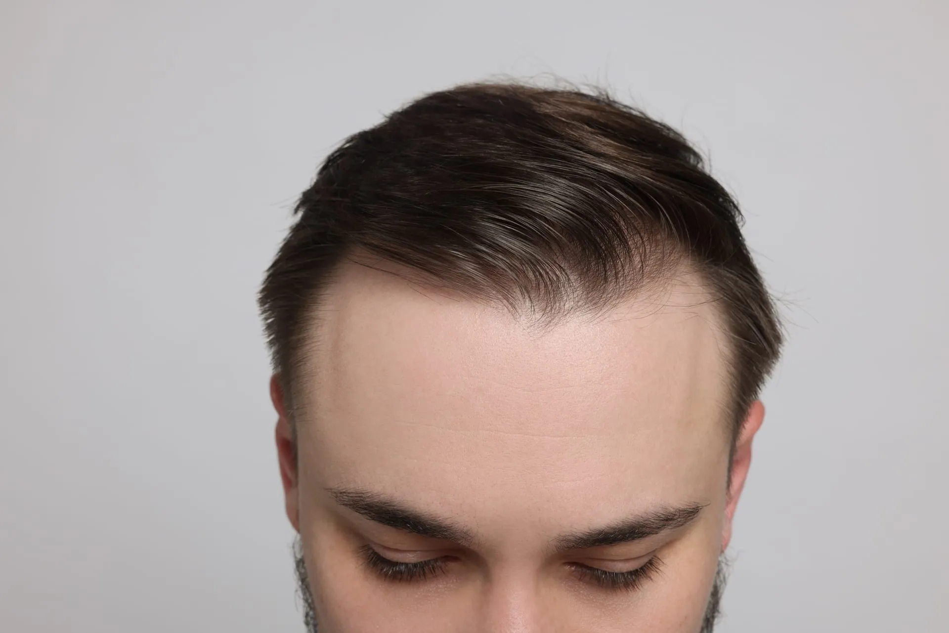 Receding hairline with receding temples