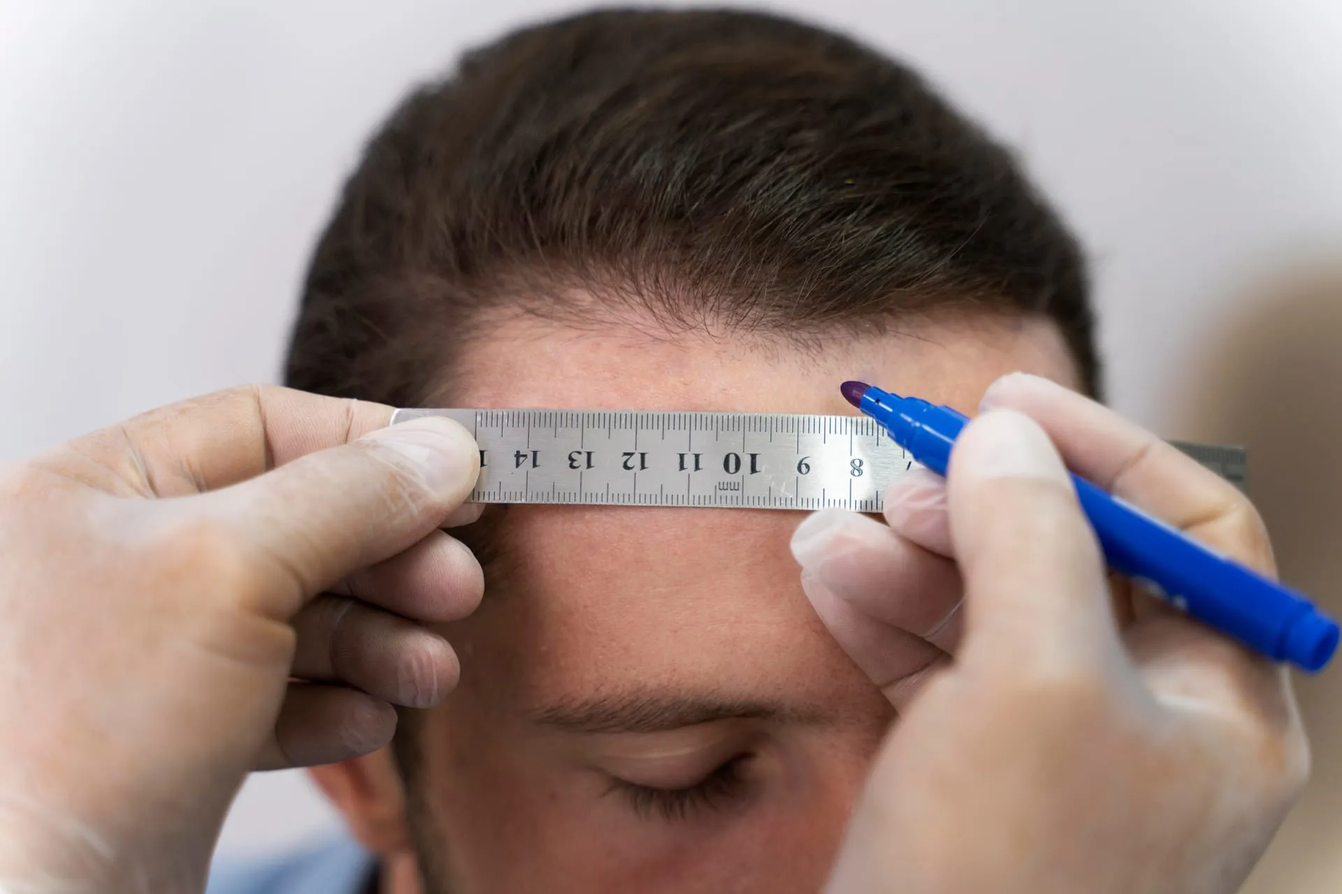 The hairline being measured with a ruler and pen before the procedure