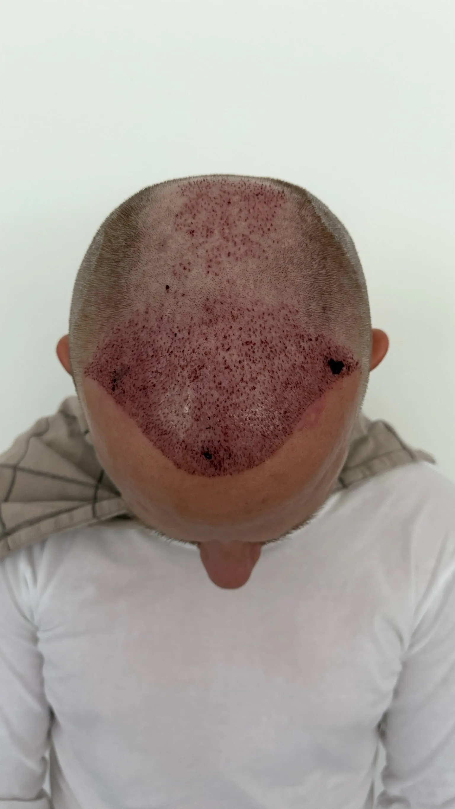 Kopfhaut von oben am 1. Tag nach der Haartransplantation