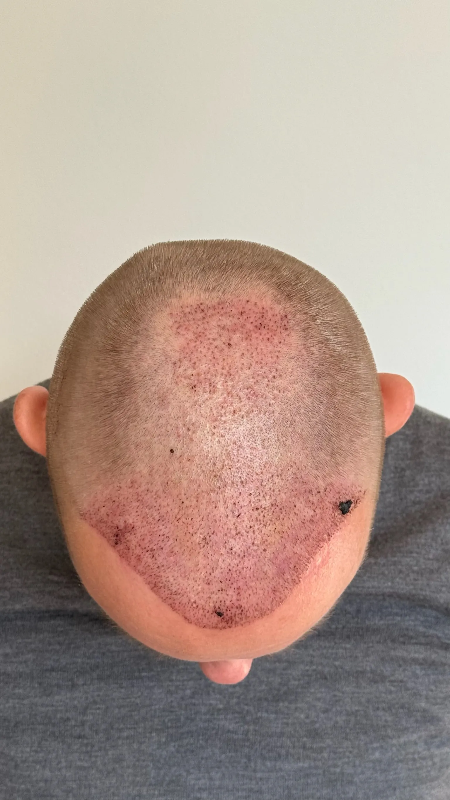 Kopfhaut von oben am 4. Tag nach der Haartransplantation