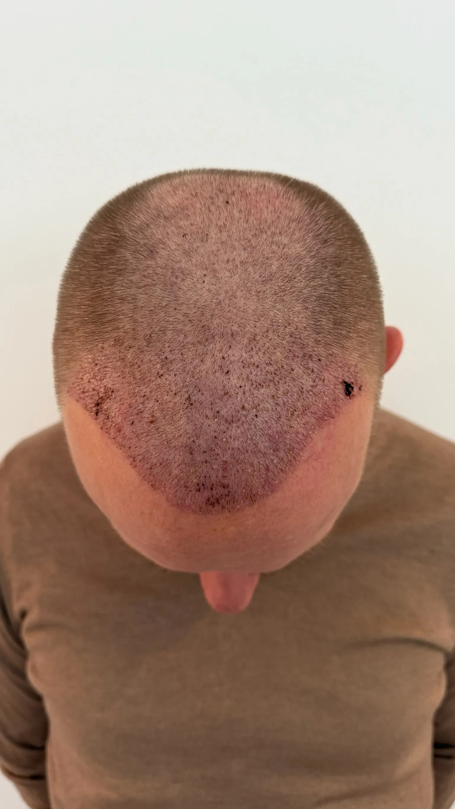 Kopfhaut von oben am 7. Tag nach der Haartransplantation