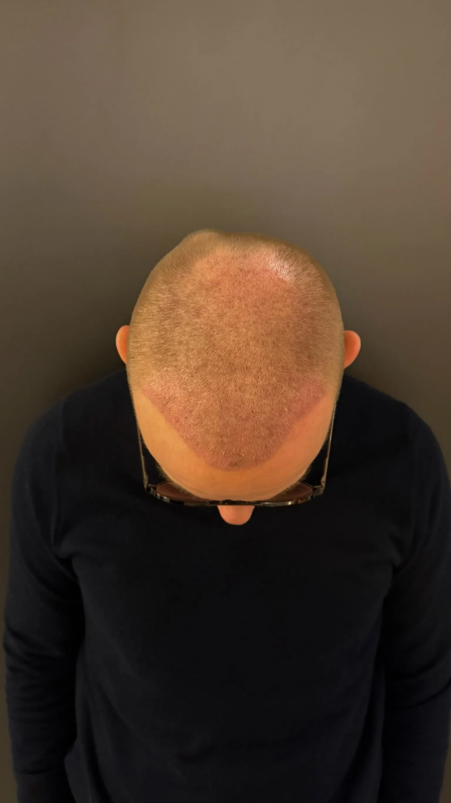 Kopfhaut von oben am 8. Tag nach der Haartransplantation